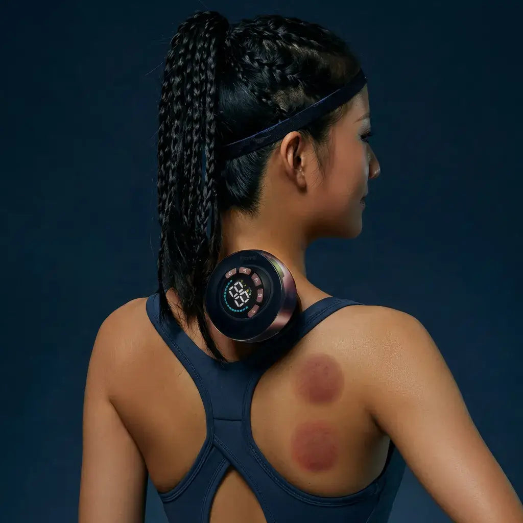 Woman using AcheFly Smart Cupping Device on her back, showcasing cups and skin markings in a relaxed setting.